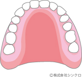 レジン床義歯