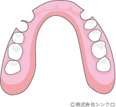 ノンクラスプデンチャー