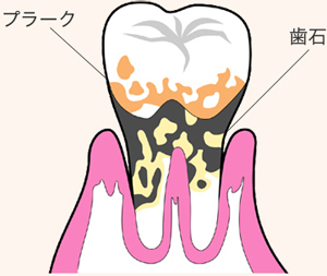 歯周病