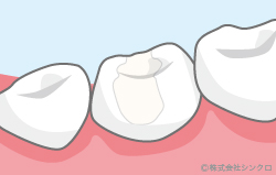 ハイブリッドセラミック